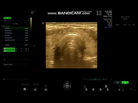 BVV – 63T – AN NINH – NHÂN THÙY PHẢI TUYẾN GIÁP (TI - 4 ) – 03 LAM KÍNH