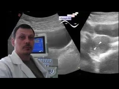 Pediatric Female pelvic ultrasound - Patchy uterus