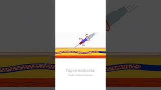 Download lagu IV Chateter Insertion mp3 Download lagu IV Chateter Insertion mp3