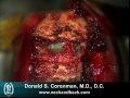 Anterior Cervical Decompression and Fusion (ACDF ...