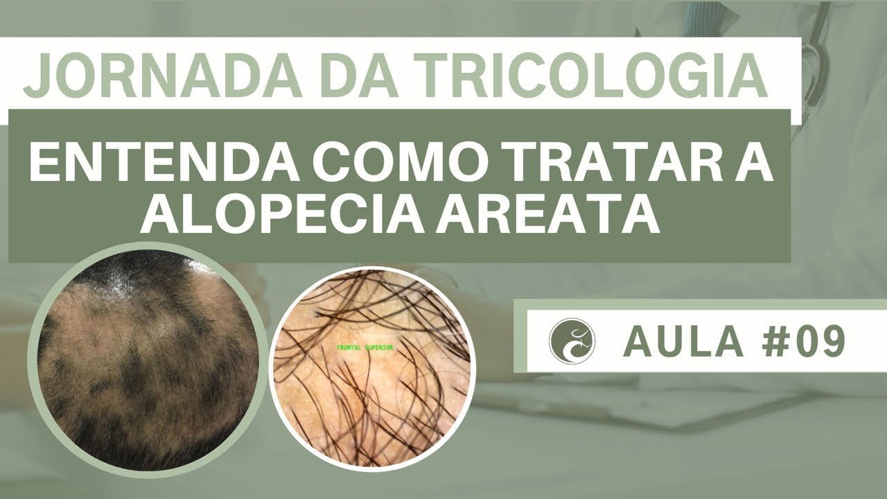 JORNADA DA TRICOLOGIA| Aula #09 Saiba como tratar a ALOPECIA AREATA| Dr João Gabriel Fernandes