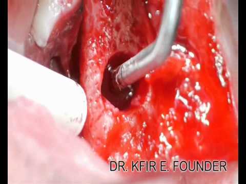 Step 2   separated by the Kyort