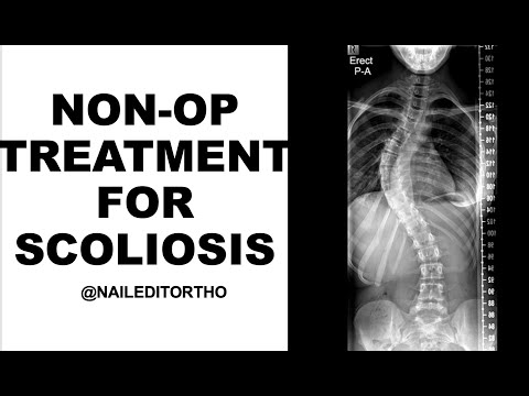 Bracing and Non-Op Scoliosis Treatment