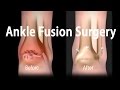Ankle Surgery Animation