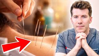 What is Acupuncture (Dry Needling)? | Doctor explains uses, benefits and potential risks