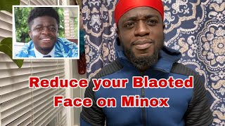 How to Reduce Your Bloated (Puffy Face) on Minoxidil