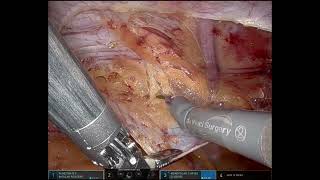 How Robotic Surgery Fixes Bilateral Inguinal Hernia | Step-by-Step Robotic TAPP Technique