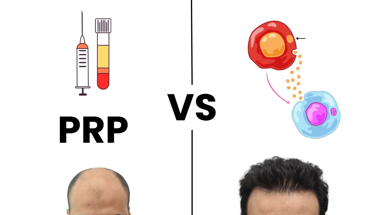 PRP vs Exosomes Hair Treatment For Hair Loss in 2026 (non-surgical)