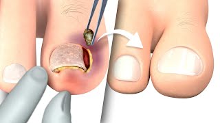 Ingrown toenail removal Treatment | Step by step