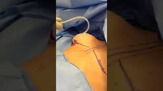 Download lagu Filling an Implant Sizer #shorts mp3