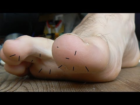 Comment retirer des épines d'oursin dans le pied