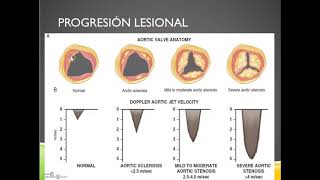 Cardiopatía Valvular - Clase I - Dr. Arturo Pazos.