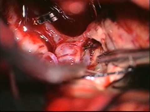 AComA: Clipping of AcomA ruptured aneurysm 