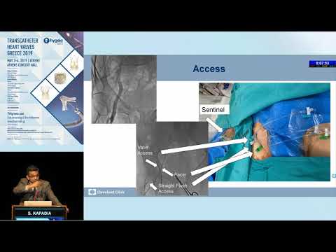 S. Kapadia | A Selective versus Routine Minimalist Strategy. Is every patient eligible?