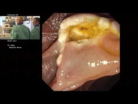 06/07 Endosummer 2019 – Live Endoskopie Teil 2