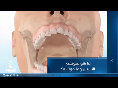 شاهد بالفيديو.. ما هو تقويم الأسنان وما فوائده؟