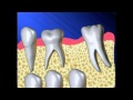 Space Maintainers for Primary Teeth | Lake Merritt Dental, Oakland, CA