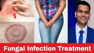 Fungal infection- Home remedies that really works | Dr. Vivek Joshi