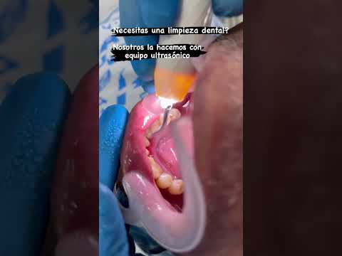 Limpieza dental profunda en Santa Marta - Odontólogo Albeiro Garcia Varela