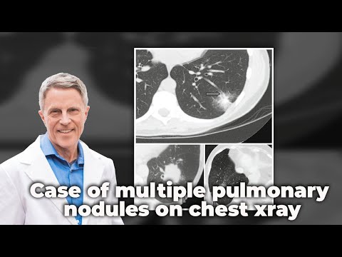 Case of Multiple Pulmonary Nodules on Chest X-ray