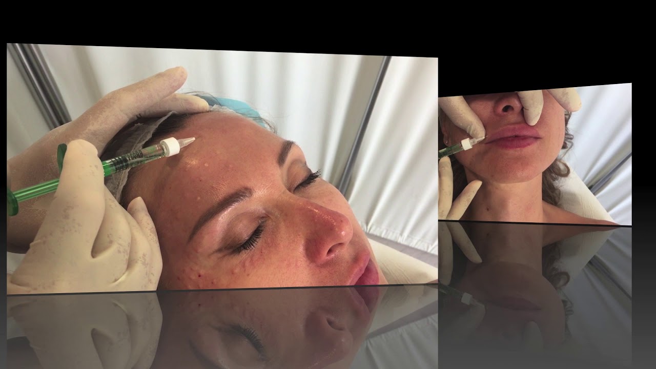 Watch Now Biostimolazione Viso Biostimolazione Viso