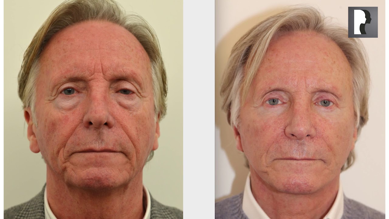 My experience of Natural facelift & neck lift surgery in London