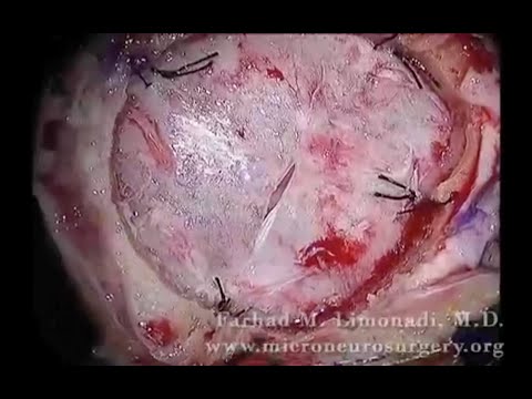 Brain Surgery - Removal of Metastatic Tumor High Power Surgical Microscope