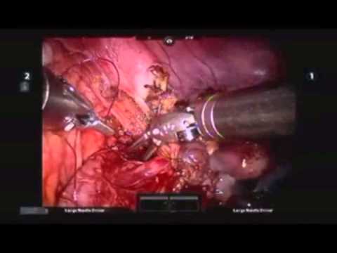 Robotic  Ureteral Surgery