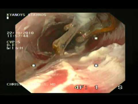 Barrett's Esophagus - Halo 360 Endoscopic Therapy