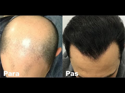 Cili është gjykimi i transplantit (mbjelljes) së flokëve?