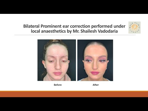 onial by a happy patient following bilateral prominent ear correction