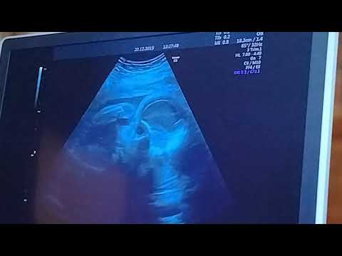 Christmas Prince 3 Royal Baby/ ultrasound