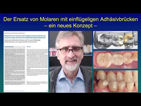 Der Ersatz von Molaren mit einflügeligen Adhäsivbrücken – ein neues Konzept –