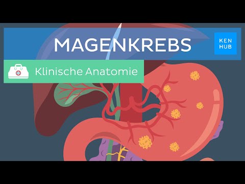Magenkrebs: Ursachen, Symptome, Diagnose, Prognose | Kenhub