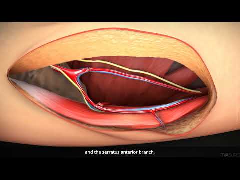 Thoracodorsal artery perforator flap harvest