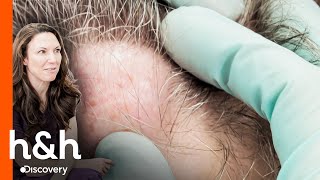 Tiene estos bultos en su cabeza hace 20 años | Clínica de la Piel | Discovery H&H