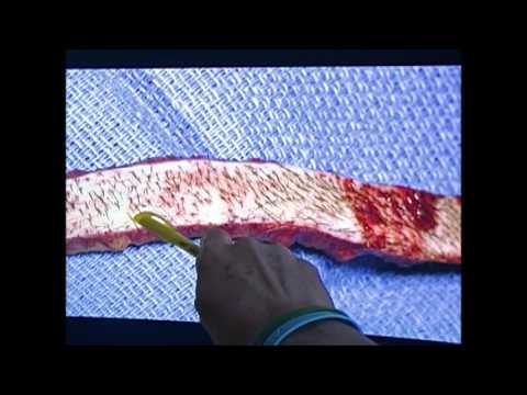 Review of Hair transplant options by Dr. Lindsey | McLean | VA | Virginia | MD | Maryland | DC thumbnail