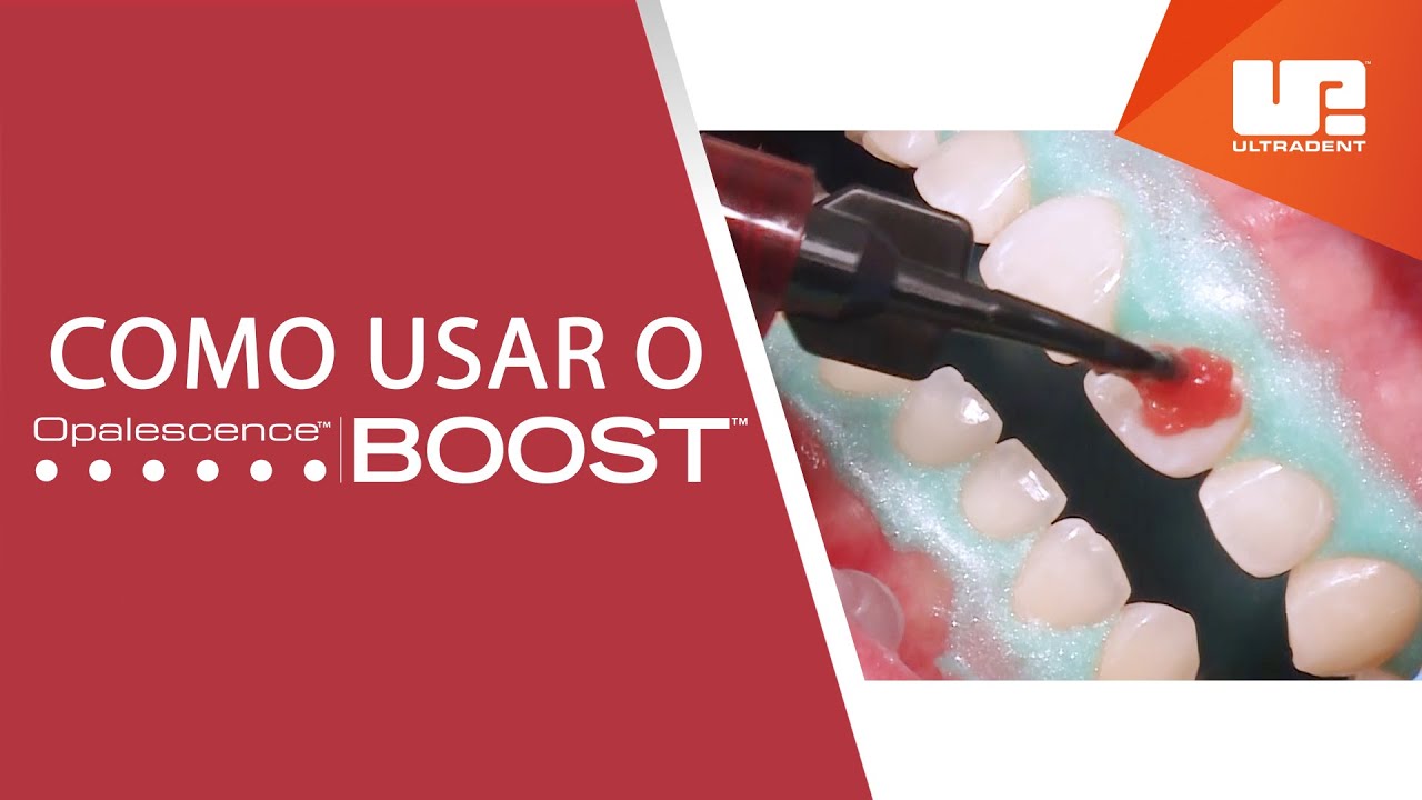 Passo a passo de como usar o clareador Opalescence ™ Boost ™