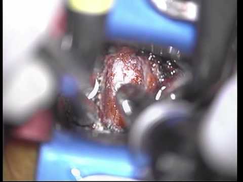 Anterior Discectomy in the Cervical Segment and Fusion with the use of Allograft