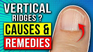 How to Get Rid of Vertical Ridges on Fingernails Naturally