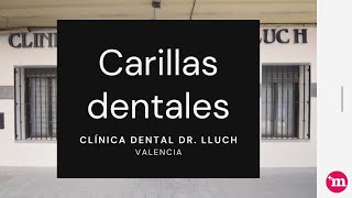 Carillas dentales en Clínica Dental Doctor  Lluch