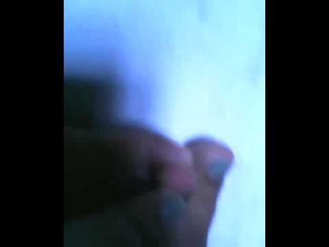 Uri ng halamang-singaw pidal Kung paano gamutin ang mga sanggol Nail Fungus