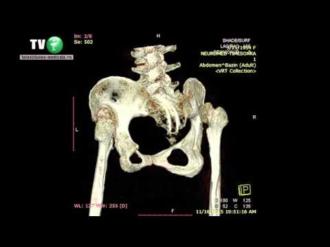 Artroza genunchiului tratament chirurgical