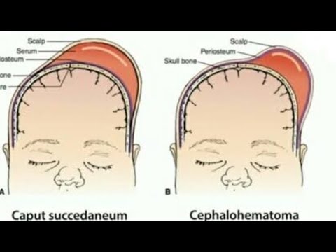 Caput succedaneum vs cephalhematoma