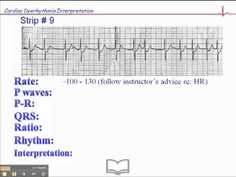 ECG: Exercise # 9