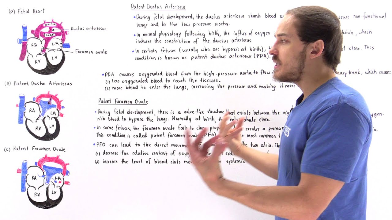 Patent Ductus Arteriosus and Patent Foramen Ovale