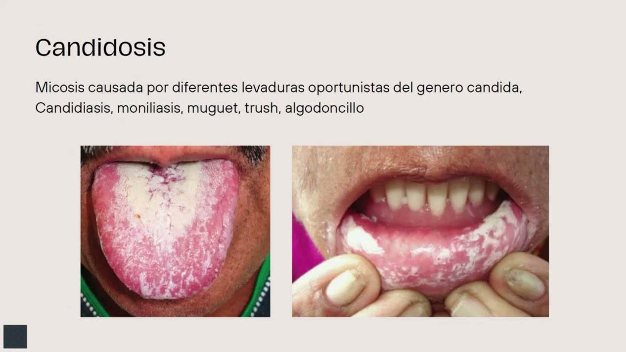 Candidiasis Oral en la persona mayor: Expresión de enfermedades ocultas.