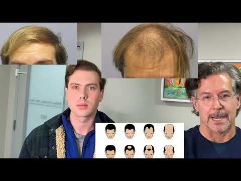 Younger patient after 2531grafts by Dr. Lindsey at 1 year with interview in McLean | VA | DC | MD thumbnail