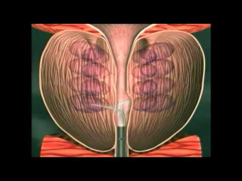 Diabete prostatite Prostata neoprotsess