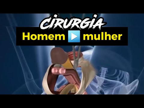 CIRURGIA REDESIGNAÇÃO SEXUAL: Homem 🔴 Mulher